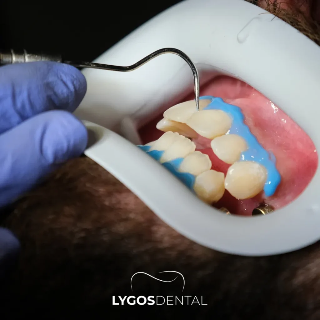 teeth whitening in turkey process