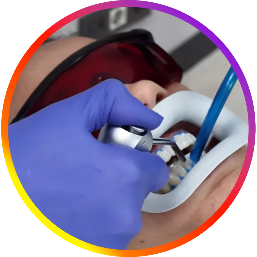 teeth whitening instagram reels