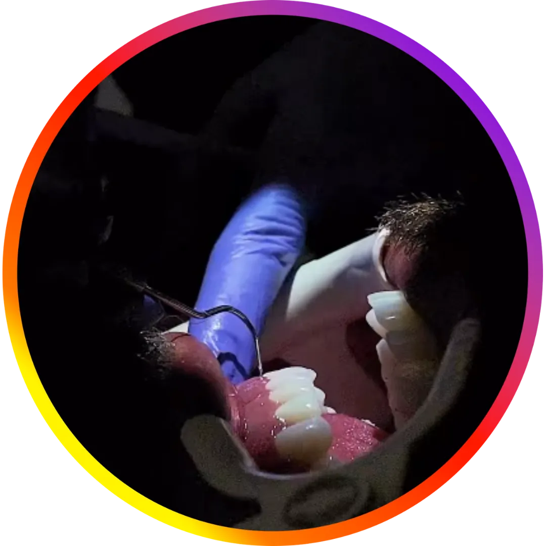 zirconia veneer instagram reels