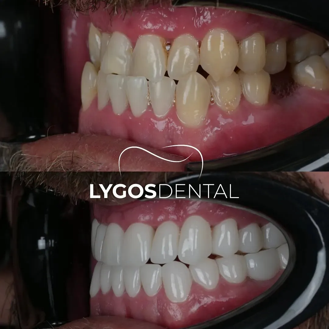 zirconium veneer before after