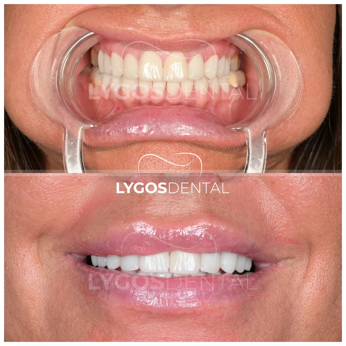 zirconium veneer before and after