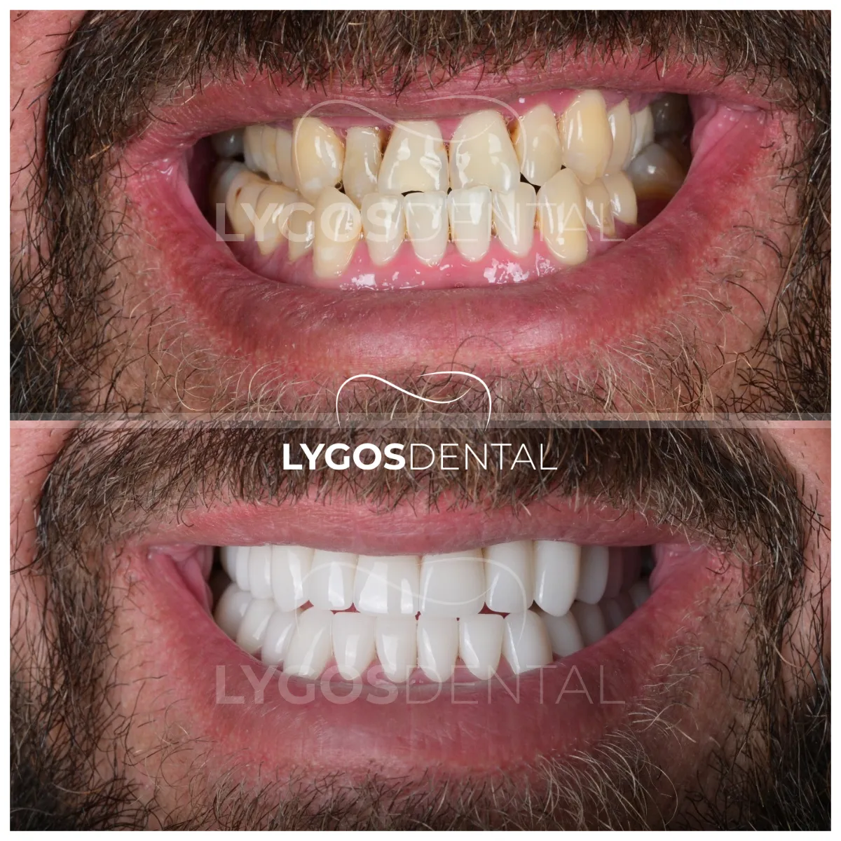 zirconium veneer before and after