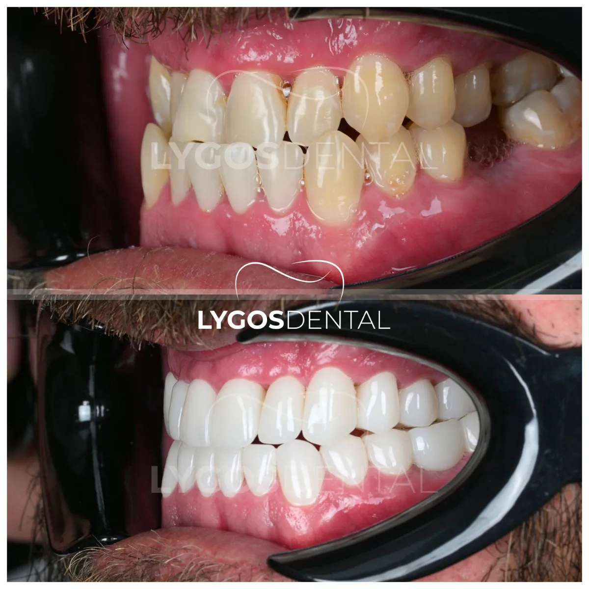 zirconium veneer before and after