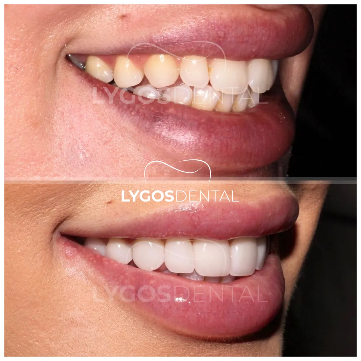 zirconium veneer before and after