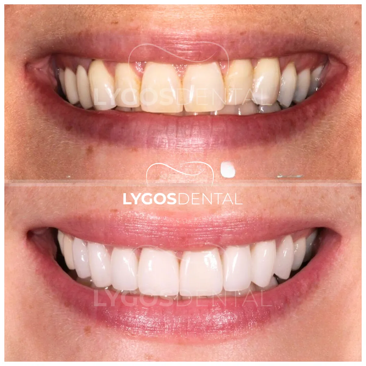 zirconium veneer before and after