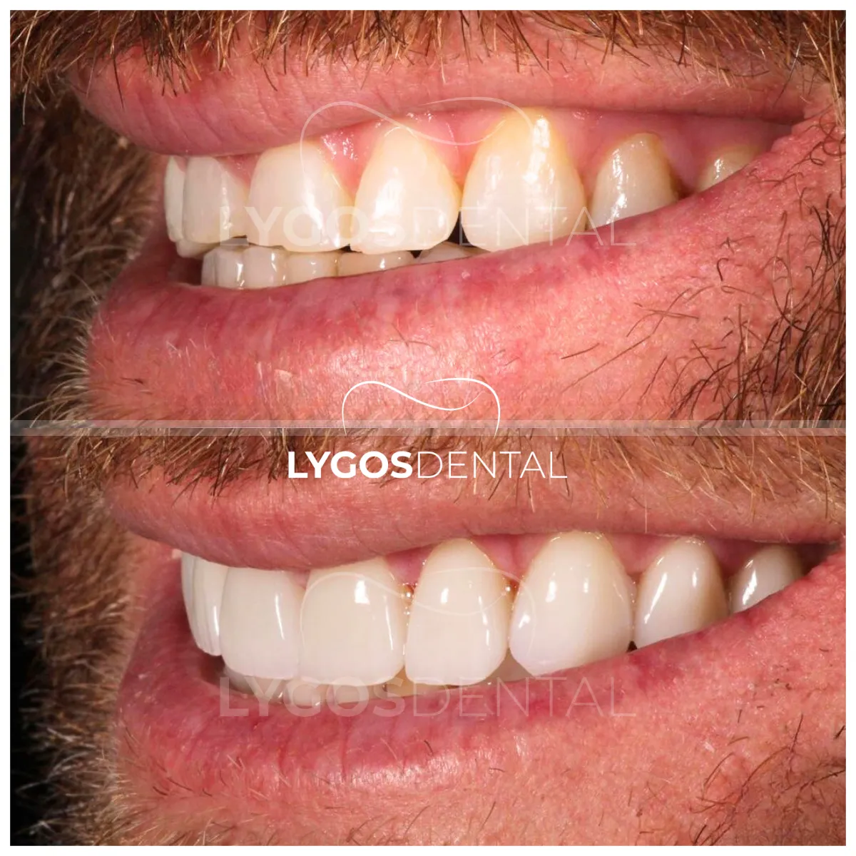 zirconium veneer before and after