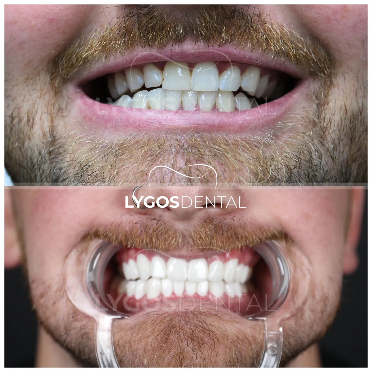 zirconium veneer before and after