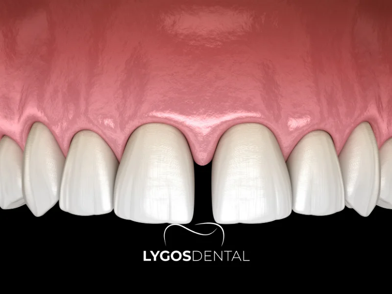Dişler Arasındaki Boşlukları (Diastema) Nasıl Kapatabilirim?
