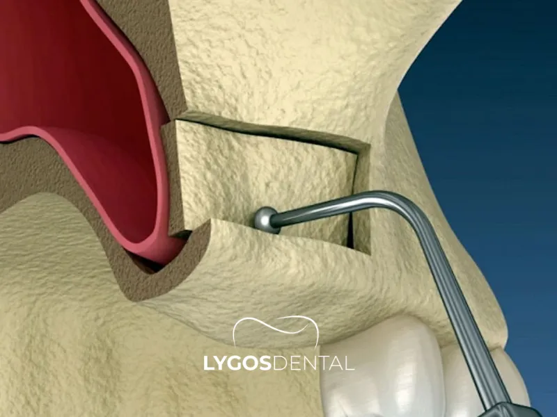 Che cos’è il sollevamento dei seni paranasali? | LYGOS DENTAL