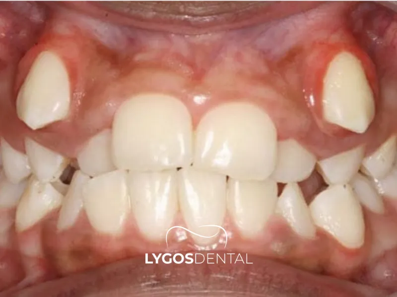 Che cos’è un dente ectopico? | LYGOS DENTAL