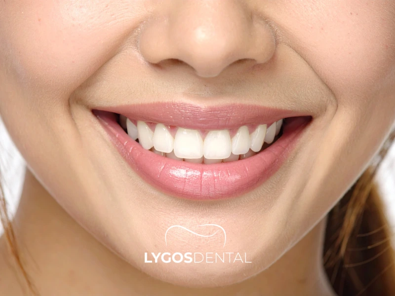 Trattamenti odontoiatrici estetici preferiti dalle celebrità