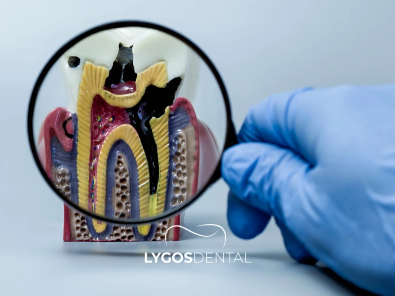 È possibile sbiancare i denti sottoposti a trattamento canalare?