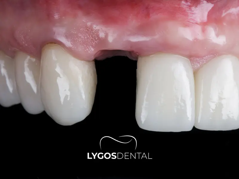 Problemi di autostima dopo la perdita di un dente