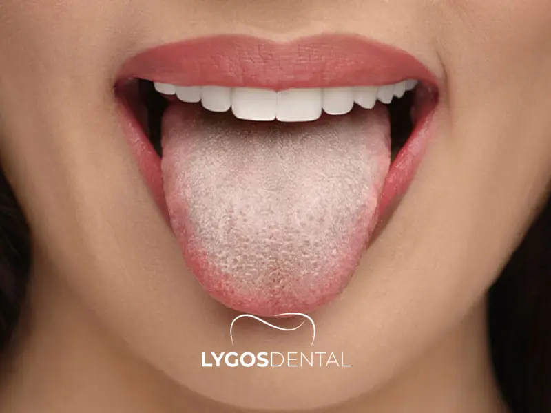 Come pulire il rivestimento della lingua?