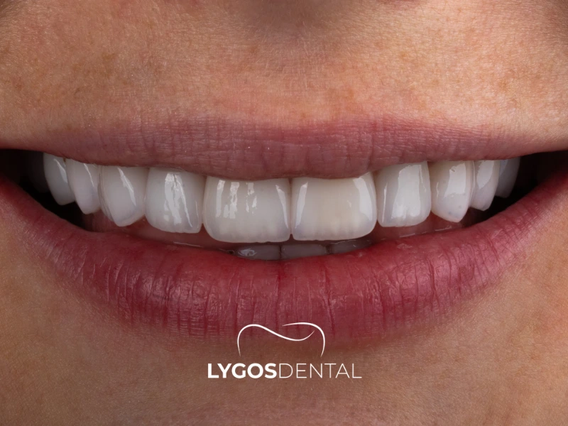 Prezzi delle faccette in laminato