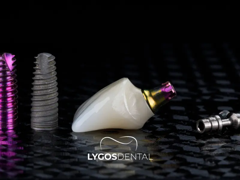 Prezzi delle corone su impianti monodentali