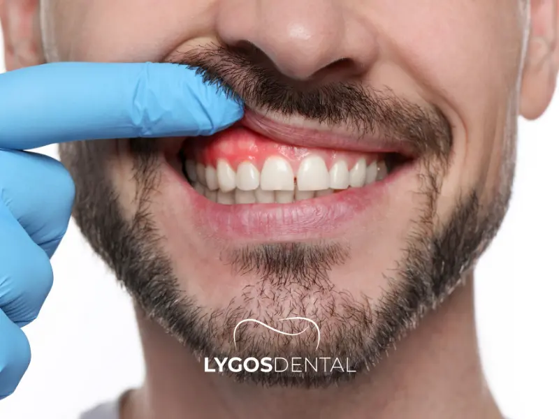 Symptome einer Zahnfleischentzündung (Gingivitis-Symptome)