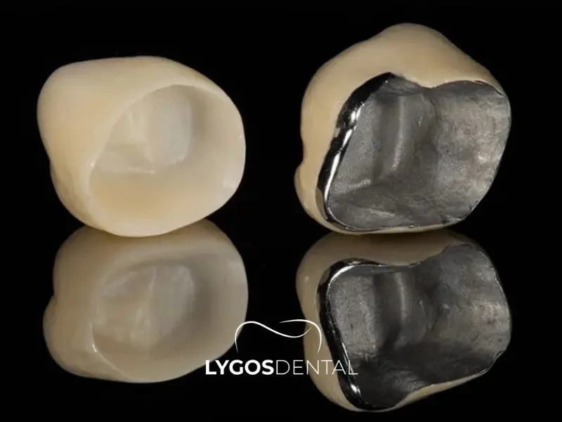 Corona in zirconio o corona su struttura metallica?