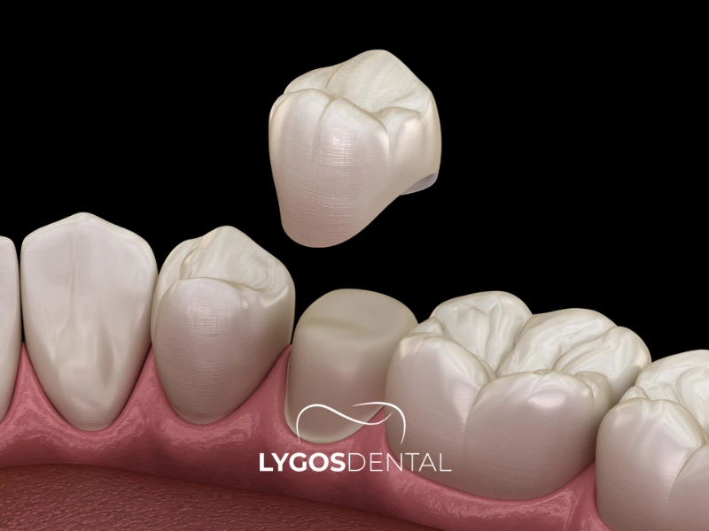 Ventajas de las coronas dentales de circonio