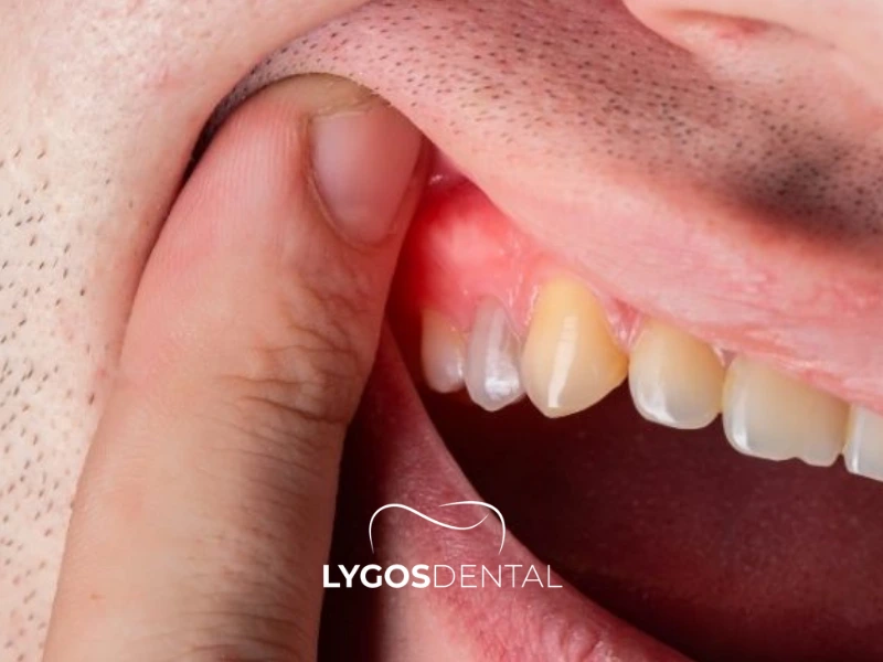 Um dente infectado pode ser extraído? | LYGOS DENTAL