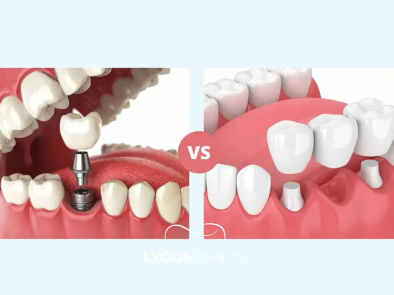 Differences Between Implants and Dental Bridges