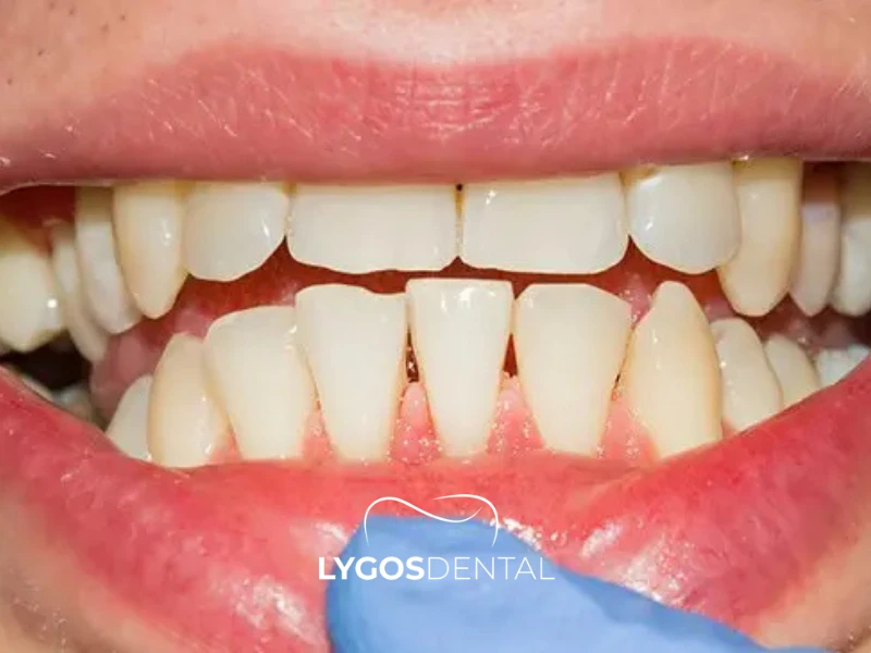 Comment prévenir la récession gingivale chez les fumeurs