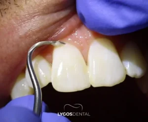 Does Tartar Cleaning Damage Tooth Enamel? | LYGOS DENTAL