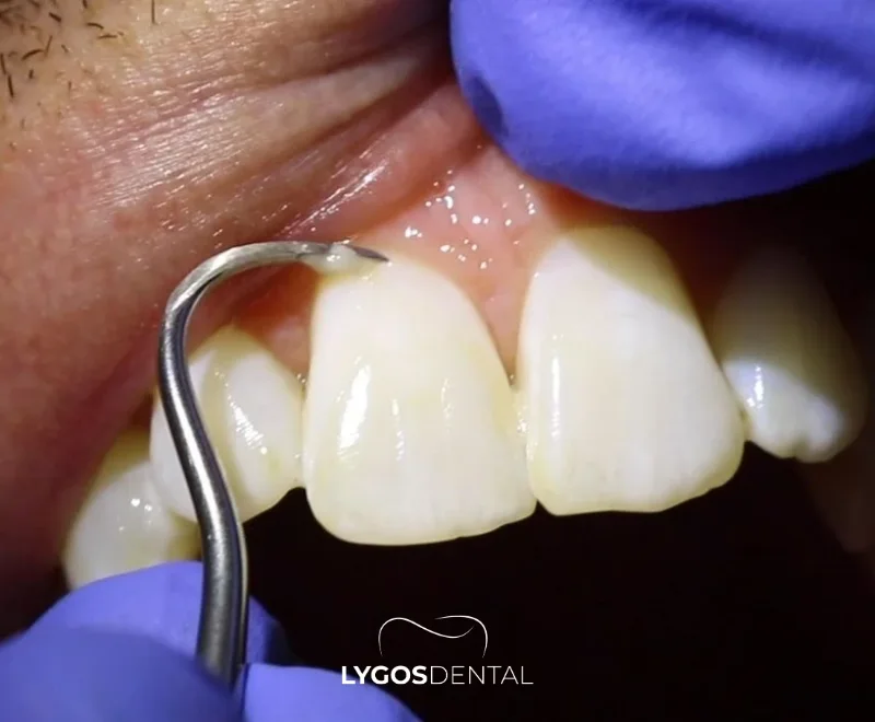 Does Tartar Cleaning Damage Tooth Enamel?