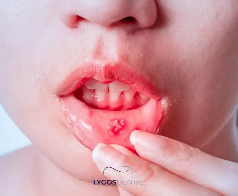 Oral Lesions in Autoimmune Diseases