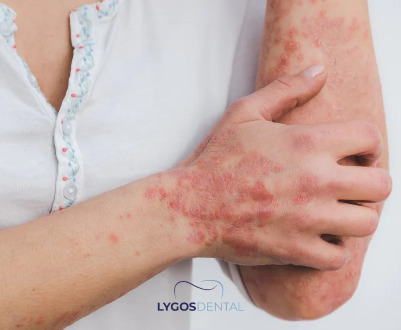 What is an Autoimmune Disease?