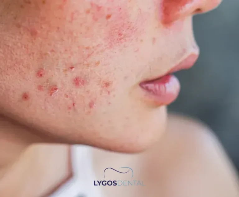 Autoimmune Diseases Most Commonly Causing Oral Lesions