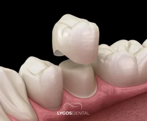 Advantages of Zirconium Dental Crowns | LYGOS DENTAL