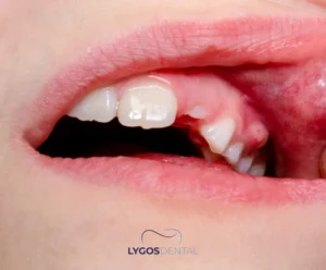 Can an Infected Tooth Be Extracted? | LYGOS DENTAL