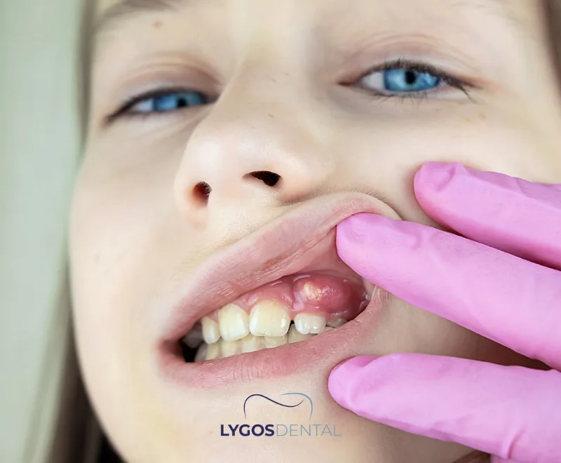 What Is an Infected Tooth?