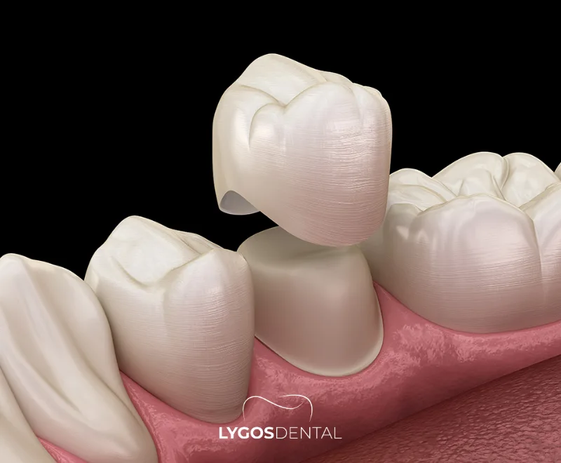 Why Are Dental Crowns So Expensive?