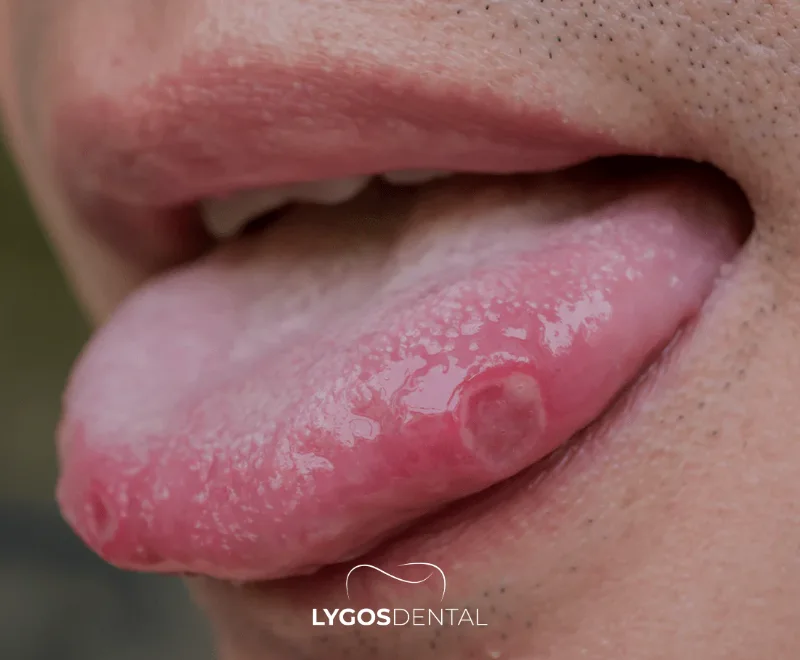 What Is a Tongue Sore?