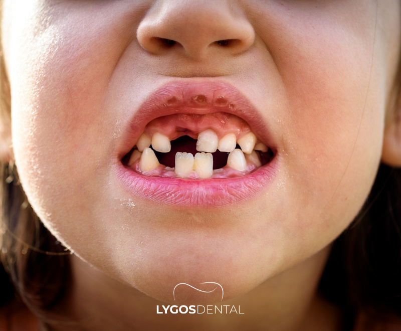 When Do Baby Teeth Fall Out?