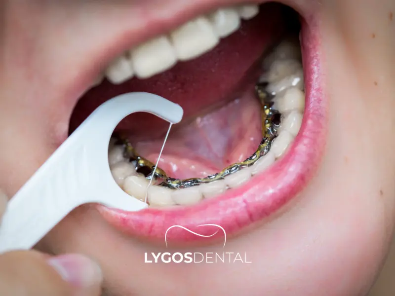 Lingual Diş Telleri Nasıl Temizlenir? | LYGOS DENTAL