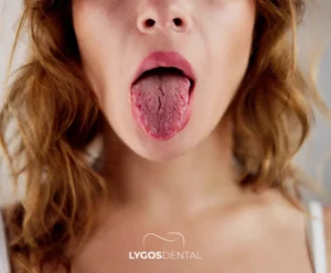 What Is Good for Dry Mouth? | LYGOS DENTAL