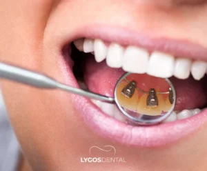 How to Clean Lingual Braces? | LYGOS DENTAL