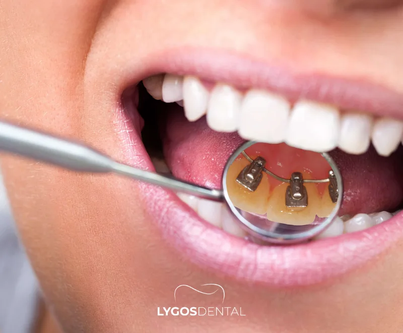 How to Clean Lingual Braces?