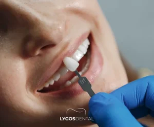 How Long Do Veneers Last? | LYGOS DENTAL