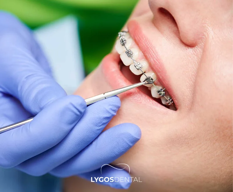 Things to Consider During Orthodontic Treatment