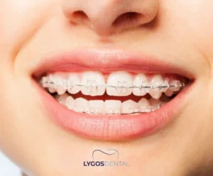 All About Invisible Braces | LYGOS DENTAL