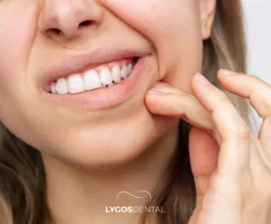 5 Practical Ways to Prevent Sensitivity After Teeth Whitening | LYGOS DENTAL