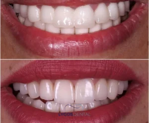 Zirconium vs Porcelain Veneers | LYGOS DENTAL