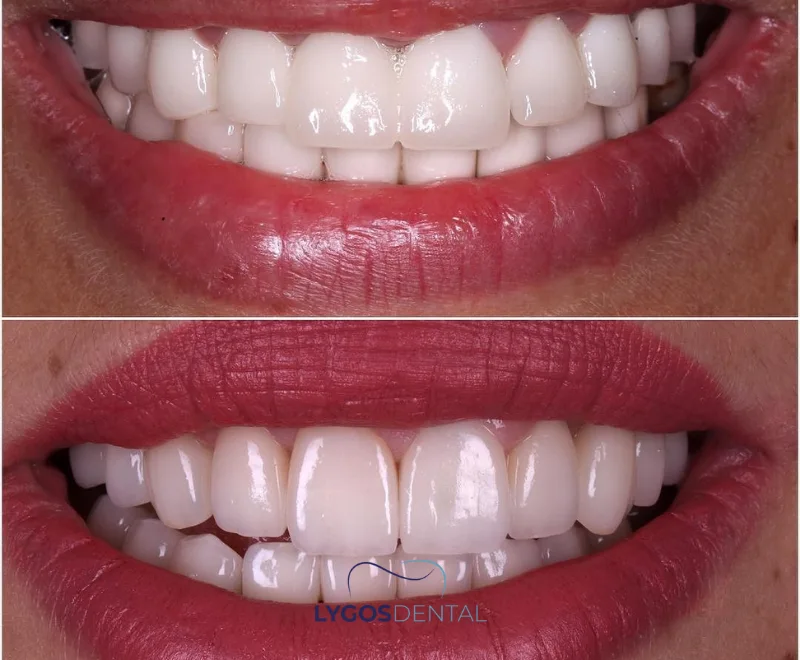 Zirconium Crown vs Porcelain Veneers