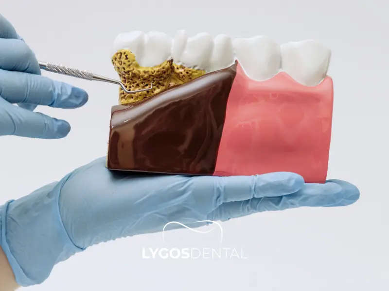 Sensibilité après un détartrage | LYGOS DENTAL