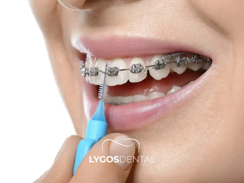 Things to Consider During Orthodontic Treatment | LYGOS DENTAL