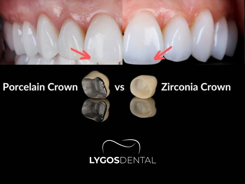 Zirconium vs Porcelain Veneers | LYGOS DENTAL